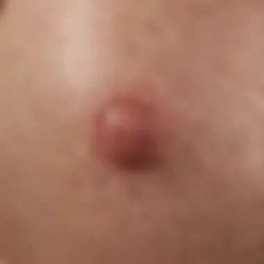 Close-up of an ingrown hair on the skin